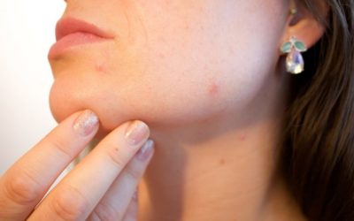 7 Tipps für saubere Haut – ohne Knöpfe – Top 10 im Jahr 2019